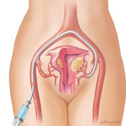 Animación de la embolización