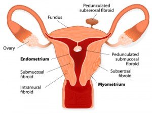 Fibroid Embolization Fibroid Embolization