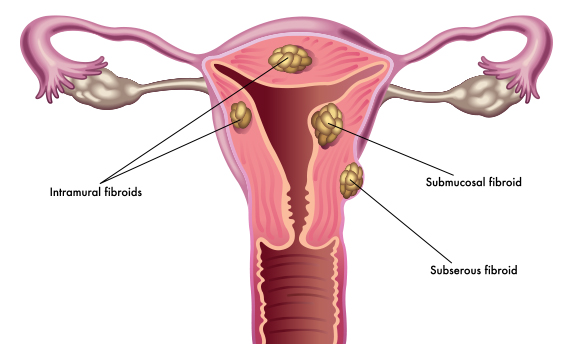 Fibroid Tumors Fibroid Tumors