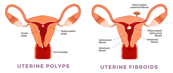 Uterine Polyps vs. fibroids Uterine Polyps vs. fibroids
