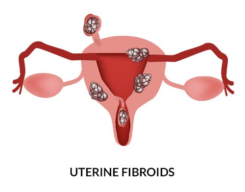 Uterine Fibroids Cause Enlarged Uterus Uterine Fibroids Cause Enlarged Uterus